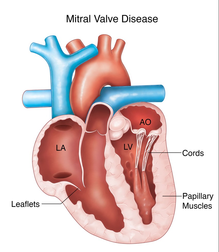 Liverpool Heart and Chest Hospital Heart Valve Disease